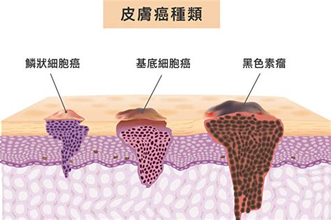 皮膚癌|皮膚癌分期治療方式？皮膚癌照片、治療費用、治癒率一次看